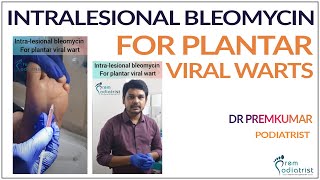 Intralesional bleomycin for plantar viralwarts DrPremkumar PodiatristinChennai verrucavulgaris [upl. by Nosille]