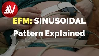 Sinusoidal pattern explained [upl. by Ait931]