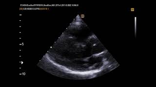 VSD with overriding of Aorta [upl. by Shatzer201]