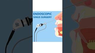 Balloon Sinuplasty vs Endoscopic Sinus Surgery [upl. by Saire]