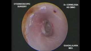 EXPLORACIÓN ENDOSCÓPICA DE MEMBRANA TIMPÁNICA PERFORADA Dr Cornejosa [upl. by Ardyth49]