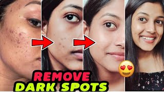 In 7 Days 😍 Remove DARK SPOTS  ACNE SCARS  PIGMENTATION  PIMPLE MARKS 100 Results [upl. by Adniles]