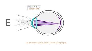 How does MiSight work [upl. by Niad]