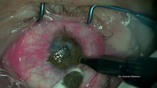 Queratopigmentacion o Tatuaje corneal [upl. by Yehs]