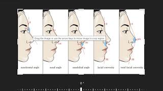 Photogrammetric Facial Analysis Asian lateral angle proportions [upl. by Aicilas]