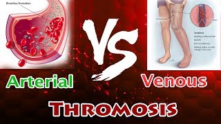 Arterial Thrombosis Vs Venous Thrombosis  Clear Comparison [upl. by Gunning650]