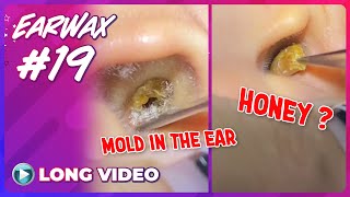 EP 19 Earwax ASMR Remove earwax from ears infected with fungus and yellow pus discharge [upl. by Yelhsa]