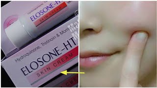 ELOSONEHT SKIN CREAM  SIDE EFFECTS  Pigmentation Killer [upl. by Salvador]