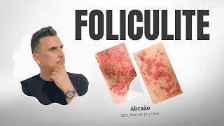 FOLICULITE O que é Quais pomadas indicadas Tratamento Medicamento [upl. by Dronel862]