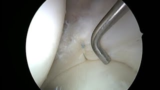 Sutura de Menisc  Meniscal Suture  DR AHMAD ALQADI [upl. by Kalbli]