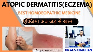 Eczema Atopic Dermatitis its permanent cure by homoeopathy [upl. by Carli68]