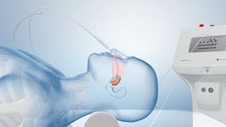 Cancer Treatment with Brachytherapy Medical Animation [upl. by Nnarefinnej]