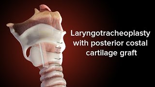 Medical Animation Posterior Cricoid Split  Cincinnati Childrens [upl. by Leverett937]