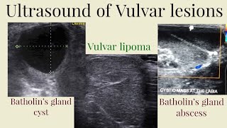 Ultrasound of Vulvar lesions Batholins gland cyst vulvar lipoma  Batholins gland abscess [upl. by Camus249]