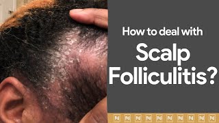 Dealing with Scalp Folliculitis Watch immediately [upl. by Bryner965]