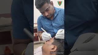 How to Remove Moles Using A Laser  Dr Sanjeeb Rout dentalclinic lasertreatment shorts [upl. by Sutelc973]