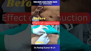 Result of laser liposuction to Remove body fat laser liposuction shorts liposuction [upl. by Groot]