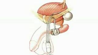 Male Urinary Incontinence New Treatments Dr Riemenschneider incontinence403 [upl. by Ellehctim286]