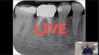 Commentaires LIVE  Retraitement endodontique  46 couronne tenons fibrés condensation verticale [upl. by Alleinad720]