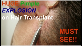 How to Pop A Pimple After Hair Transplant [upl. by Corydon340]