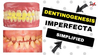 Dentinogenesis Imperfecta Simplified [upl. by Peterus]