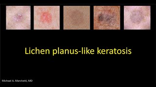 Lichen planus like keratosis  DrMMarchetti [upl. by Isdnil300]