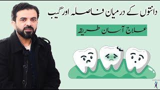 Gap or Diastema Between Teeth Causes Treatment amp Prevention in Urdu Iدانتوں کے درمیان فاصلہ اور گیب [upl. by Countess]