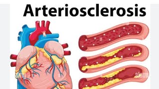 Baryta Mur 30 for Rhinosinusitis The White blood Corpuscle increase Arteriosclerosis Tonsillitis [upl. by Swords768]