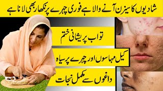 ONE SOLUTION  REMOVE ACNE SCARS PIMPLES AT HOME  GUARANTEED  Dr Bilquis Shaikh [upl. by Tail594]