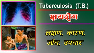 Tuberculosis TB in Nepali Causes of TB  Sign Symptoms and Treatment of TB in Nepali [upl. by Yedsnil]