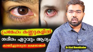 പ്രമേഹം കണ്ണുകളിൽ ബാധിക്കുന്നതിന്റെ ആദ്യ ലക്ഷണങ്ങൾ Dr Afzal Manakkadan [upl. by Elwood36]