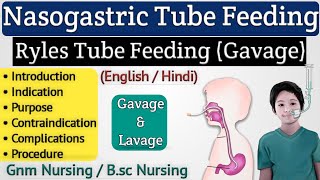 Nasogastric Tube Feeding Gavage  NG Tube Feeding  Ryles Tube Feeding [upl. by Garner]