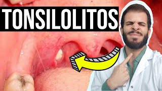 TONSILOLITOS👄💀 ¿Cómo ELIMINAR las bolitas blancas de la garganta [upl. by Ahseikram]