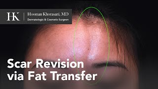 Treatment of Morphea en coup de sabre using Fat Transfer for forehead scar  Dr Hooman Khorasani [upl. by Nymassej28]