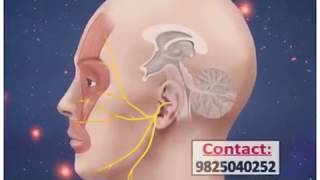 Trigeminal neuralgia treatment radio frequency ablation in ahmedabad gujrat [upl. by Eindys]