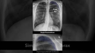 Simple Pneumothorax Chest Xray shorts [upl. by Enajaras]