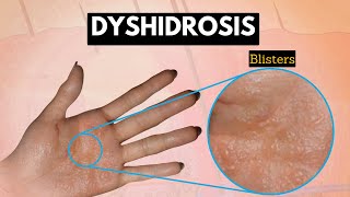 Dyshidrosis Causes Signs and Symptoms Diagnosis and Treatment [upl. by Mcloughlin]