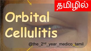 ORBITAL CELLULITIS  தமிழில்  Ophthalmology  MBBS [upl. by Sarad]