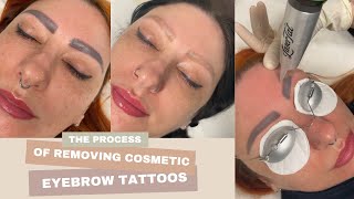 Cosmetic Eyebrow Tattoo Removal  Laser Tattoo Removal [upl. by Nolyar]