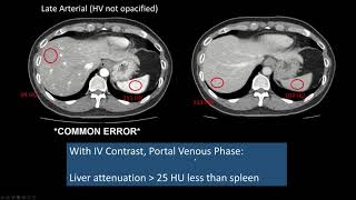 Interpreting CT Abdo Background Liver Hepatic Steatosis High Attenuation Liver [upl. by Riamo510]