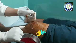 Blunt injury Knee  Traumatic Haemarthrosis Aspiration  Depression fracture Tibia  Adamya Hosp Vid [upl. by Rawdan937]