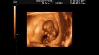 Amazing Dancing Baby in the Womb 11 Weeks [upl. by Oigolue]