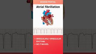 Atrial Fibrillation Anatomy ECG icu medicine emergencymedicine atrialfibrillation [upl. by Remle]