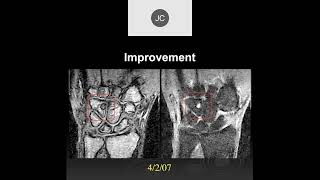 MRI of the Wrist Part 14  Wrist Inflammation [upl. by Ecirtnom]