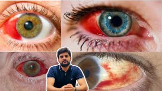 Subconjunctival hemorrhage eye blood education optometry drhashimjabbar subcribemychannel [upl. by Ewart]