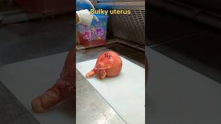 Bulky fibroid uterus பருமனான ஃபைப்ராய்டு கருப்பை  tissuefixation tissuepreparation histo [upl. by Illa]