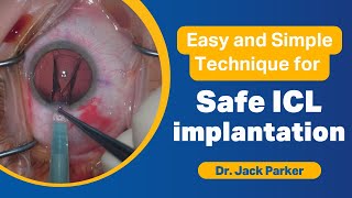 Easy and Simple Technique for Safe ICL implantation [upl. by Adlare]