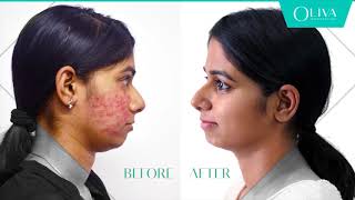 How To Remove Pimples  Professional Treatments For Acne [upl. by Lamrej]