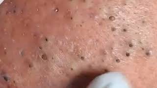 Remove dense blackheads from the face  Cleansing the skin from pimples [upl. by Robson]