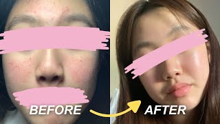 HOW I GOT RID OF MY ACNE and got GLASS SKIN  my 1 product for acne skincare routine extra tips [upl. by Silbahc814]